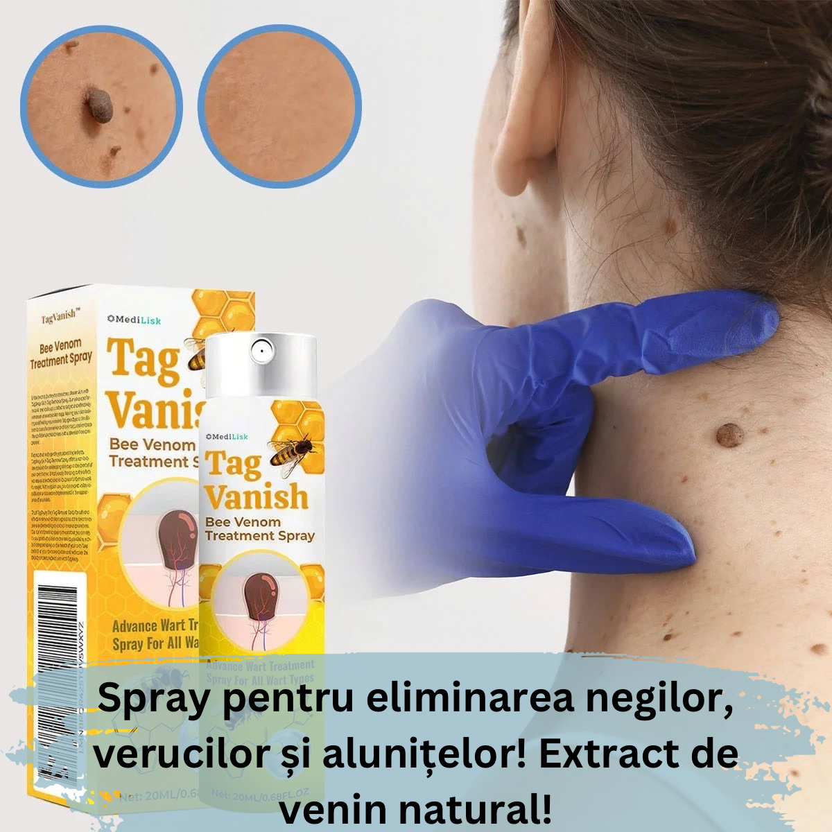 Spray pentru Eliminarea Negilor, Verucilor și Alunițelor cu Extract de ...